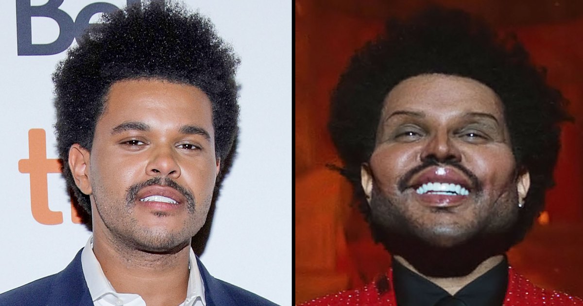 Bandages are off: The Weeknd opts for a plastic surgery, this is how he ...