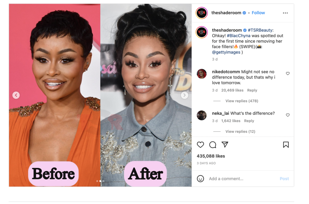 &#8216;Don&#8217;t Even Do It Y&#8217;all, It&#8217;s Not Worth It,&#8217; Blac Chyna warns fans about face fillers as she attempts a second removal, EntertainmentSA News South Africa